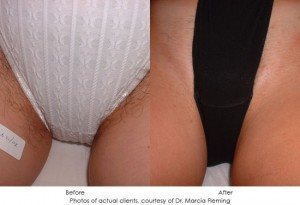 laser-hair-removal-img3-1