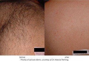 laser-hair-removal-img4