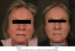 photorejuvenation-img10-1